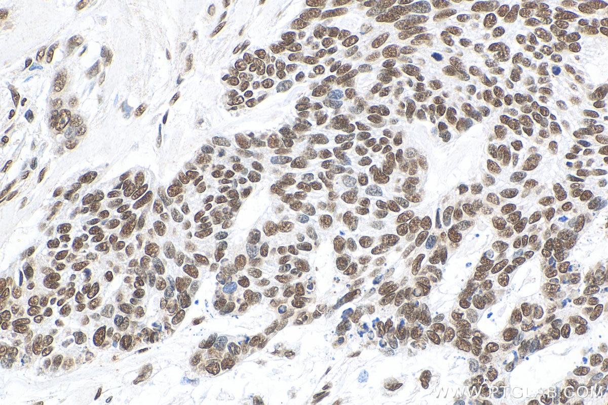 Immunohistochemistry (IHC) staining of human skin cancer tissue using Histone H3 Polyclonal antibody (17168-1-AP)