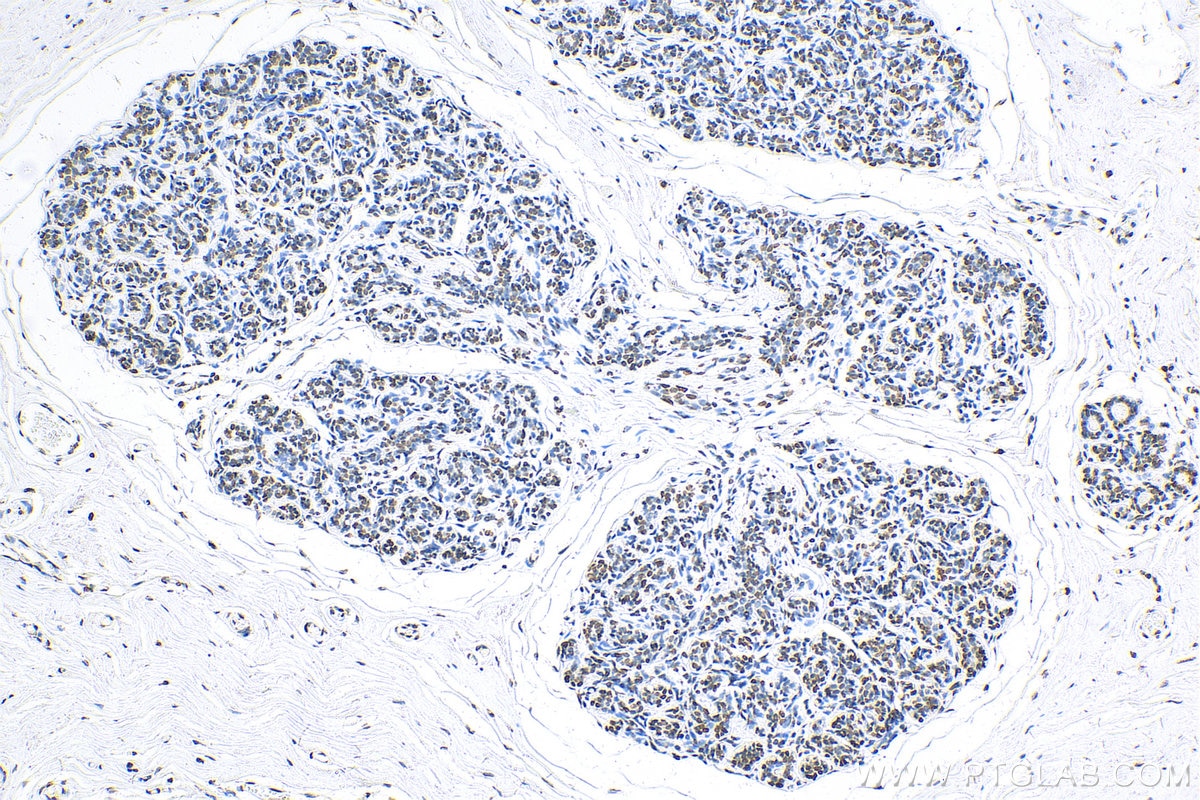 Immunohistochemistry (IHC) staining of human breast cancer tissue using Histone-H3 Polyclonal antibody (17168-1-AP)