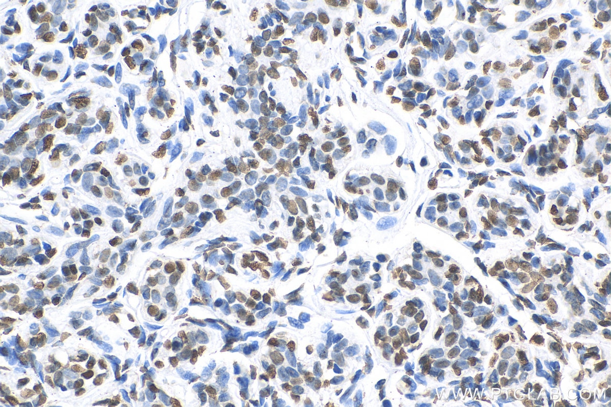 Immunohistochemistry (IHC) staining of human breast cancer tissue using Histone-H3 Polyclonal antibody (17168-1-AP)