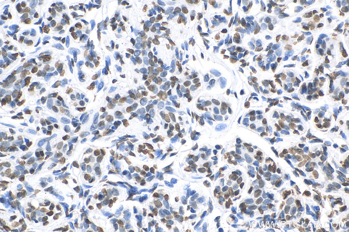 Immunohistochemistry (IHC) staining of human breast cancer tissue using Histone H3 Polyclonal antibody (17168-1-AP)