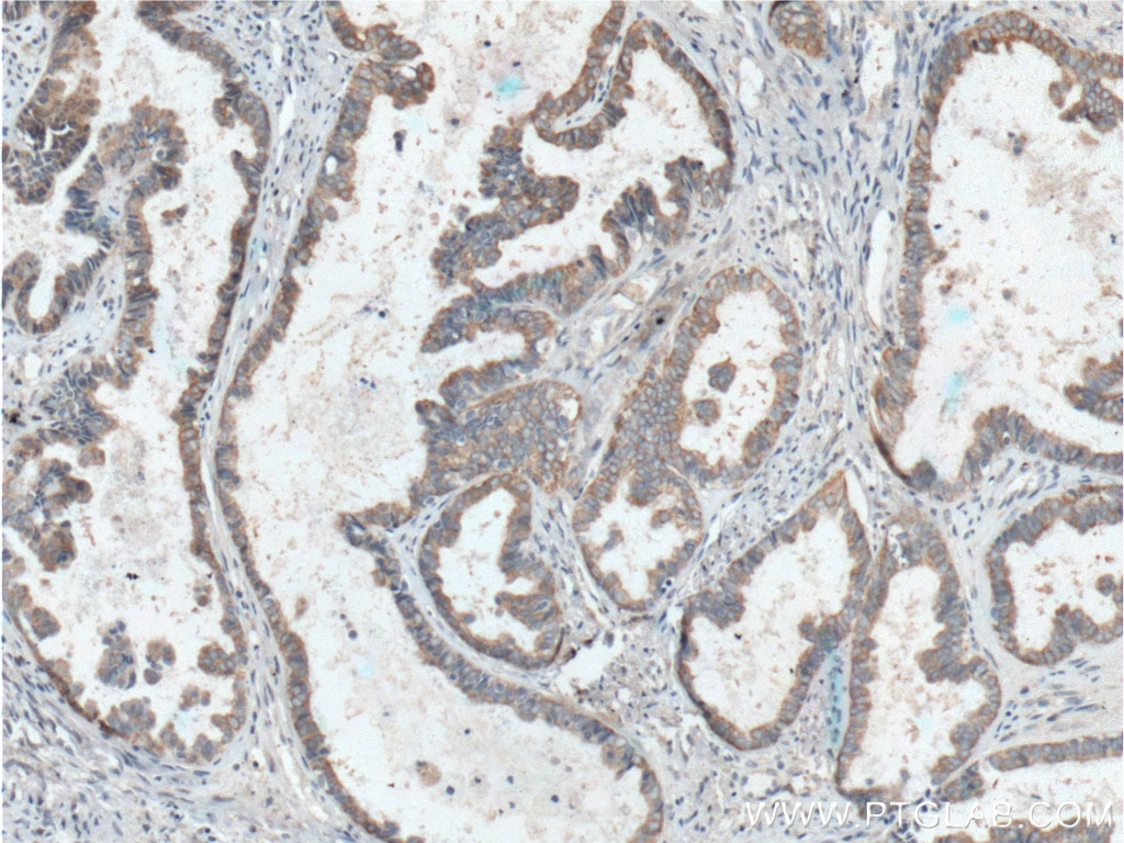 Immunohistochemistry (IHC) staining of human ovary tumor tissue using Hsc70 Monoclonal antibody (66442-1-Ig)