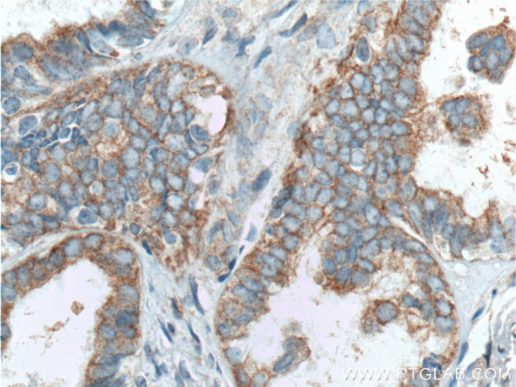 Immunohistochemistry (IHC) staining of human ovary tumor tissue using Hsc70 Monoclonal antibody (66442-1-Ig)
