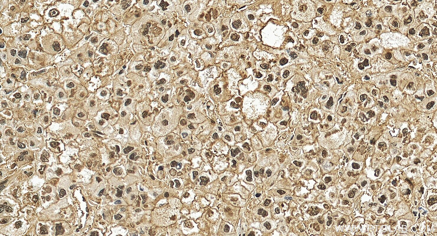 Immunohistochemistry (IHC) staining of human liver cancer tissue using Hsc70 Recombinant monoclonal antibody (81719-2-RR)