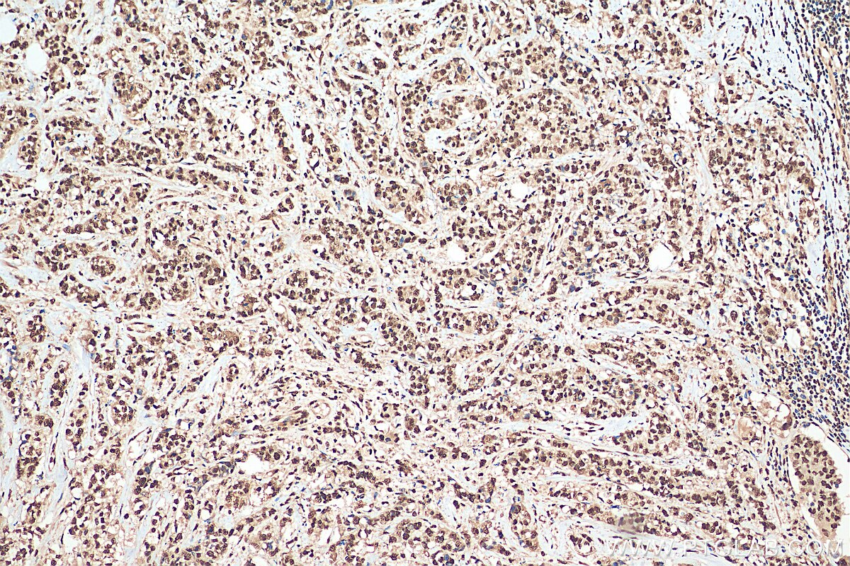 Immunohistochemistry (IHC) staining of human breast cancer tissue using HuR/ELAVL1 Polyclonal antibody (11910-1-AP)