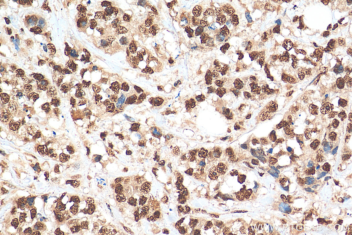 Immunohistochemistry (IHC) staining of human breast cancer tissue using HuR/ELAVL1 Polyclonal antibody (11910-1-AP)