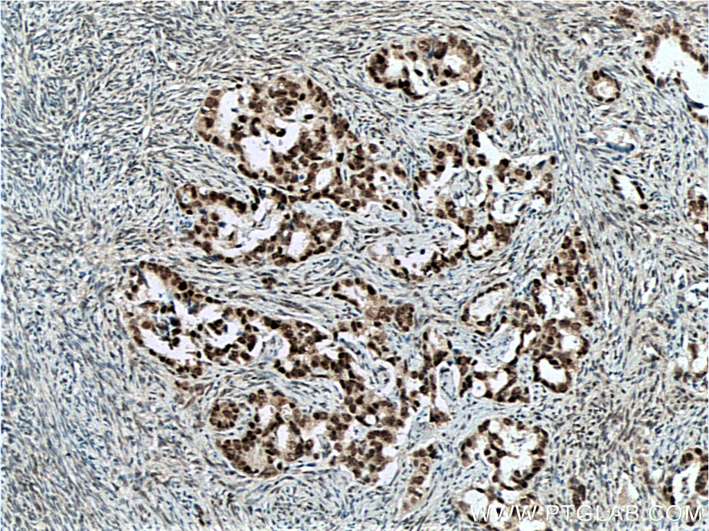 IHC staining of human ovary tumor using 66549-1-Ig