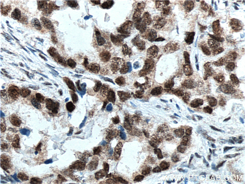 Immunohistochemistry (IHC) staining of human ovary tumor tissue using HuR/ELAVL1 Monoclonal antibody (66549-1-Ig)