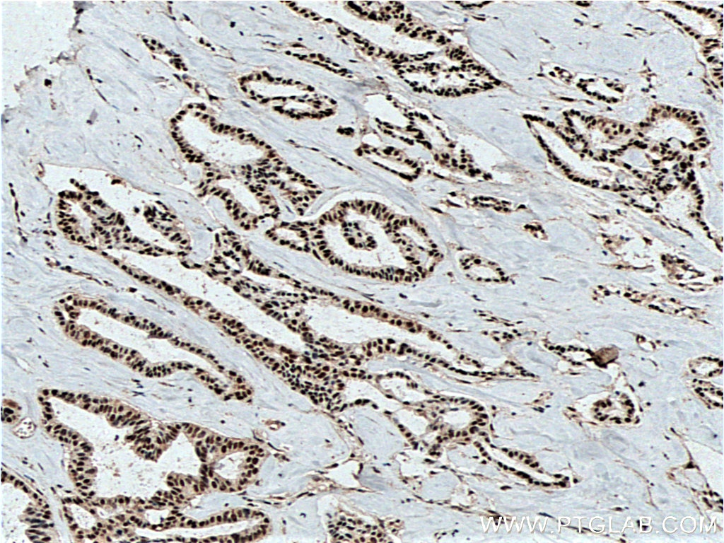 Immunohistochemistry (IHC) staining of human breast cancer tissue using HuR/ELAVL1 Monoclonal antibody (66549-1-Ig)