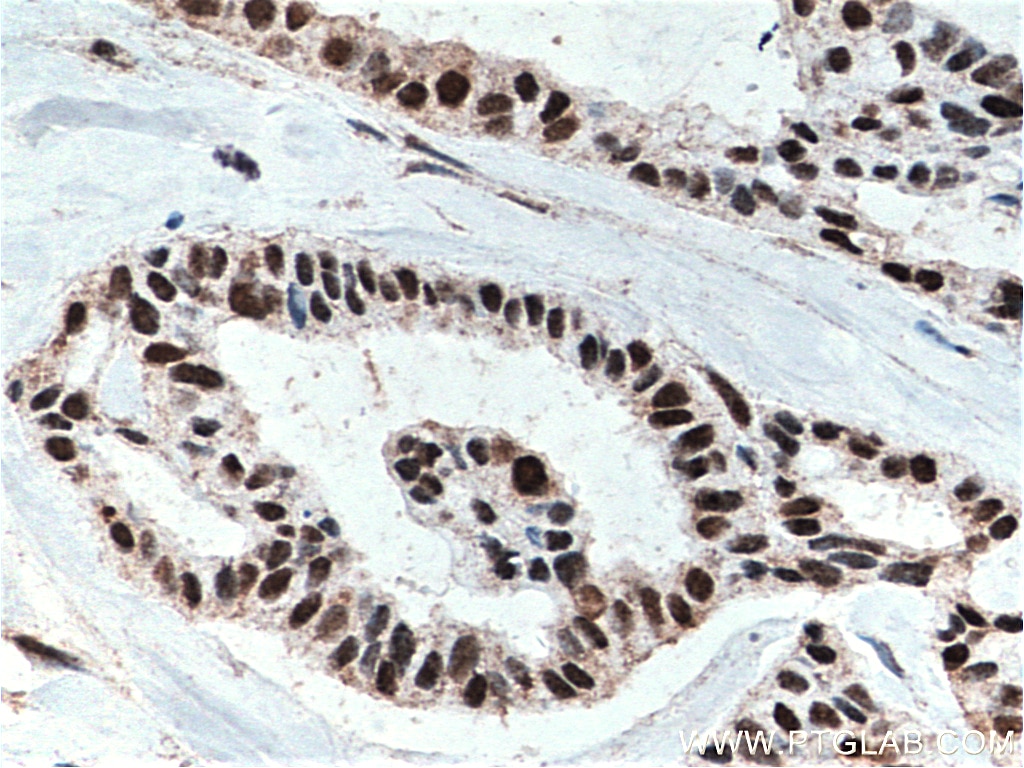 Immunohistochemistry (IHC) staining of human breast cancer tissue using HuR/ELAVL1 Monoclonal antibody (66549-1-Ig)