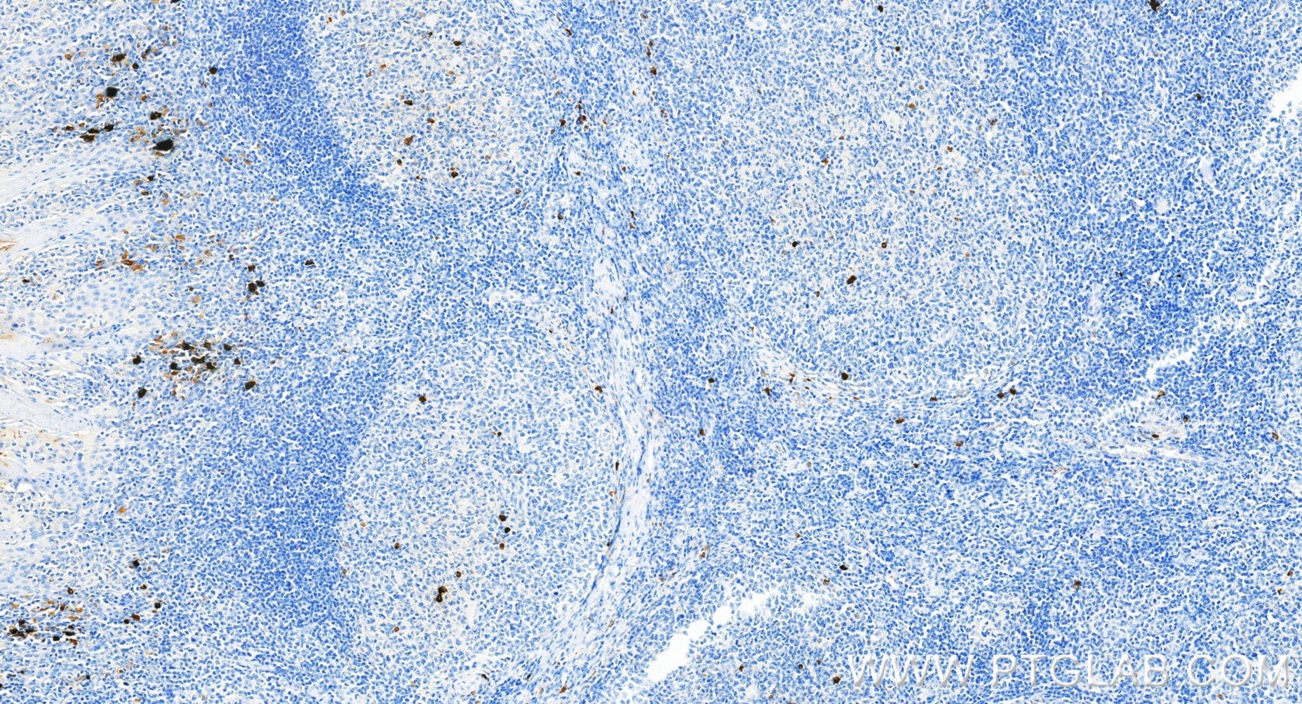 Immunohistochemistry (IHC) staining of human tonsillitis tissue using Anti-Human Human Ig Lambda Light Chain Rabbit Reco (98723-2-RR)