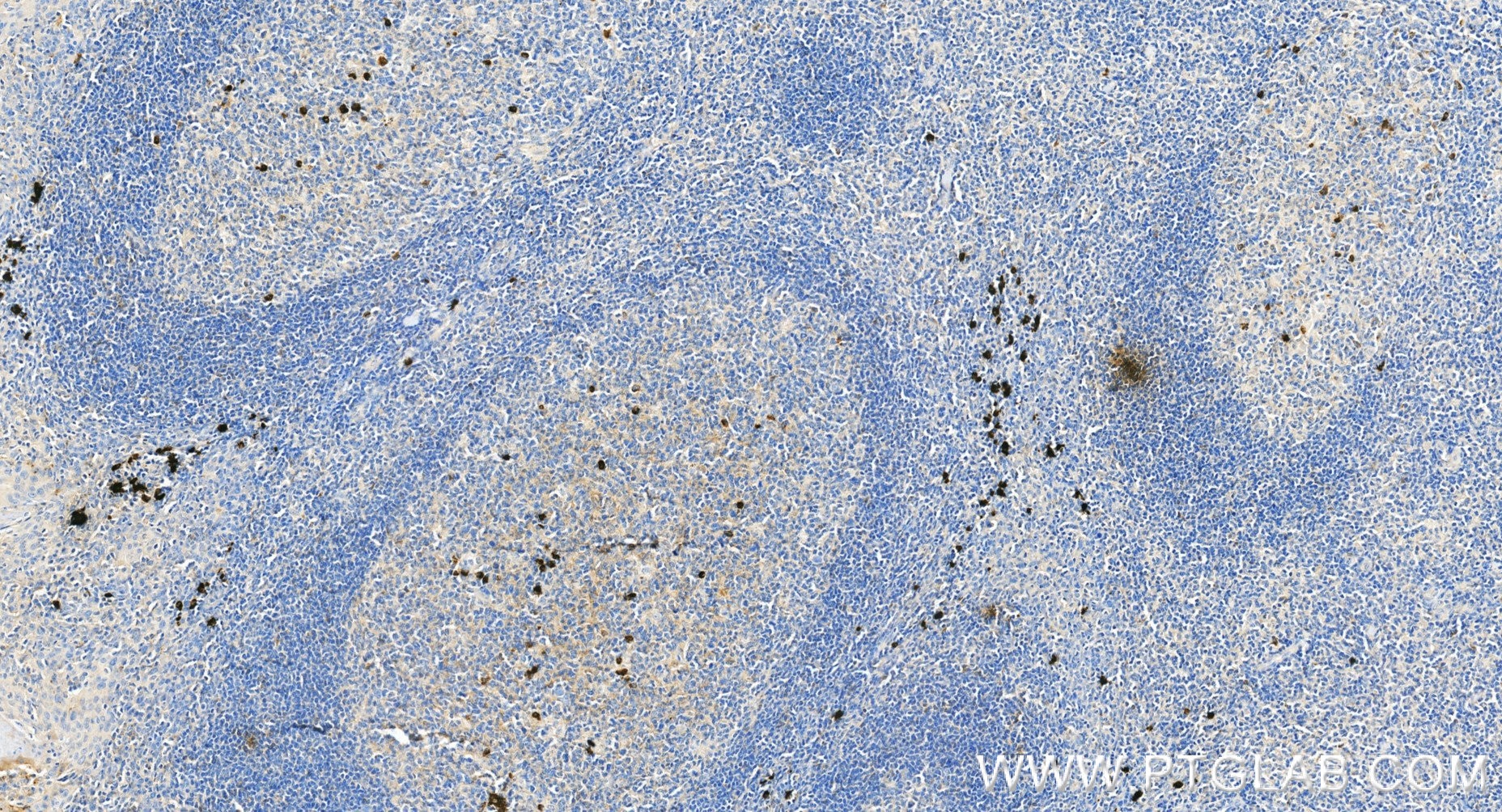IHC staining of human tonsillitis using 87680-2-RR Immunohistochemistry (IHC) staining of human tonsillitis tissue using Human Ig, λ Light Chain 1 Recombinant monoclonal a (87680-2-RR)