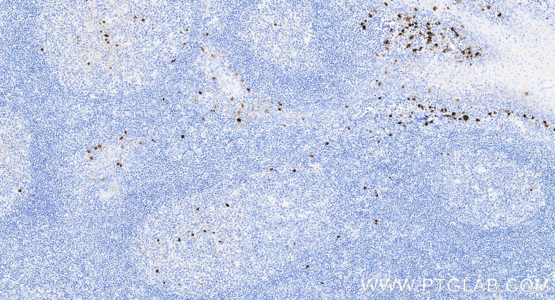 IHC staining of human tonsillitis using 87680-2-RR Immunohistochemistry (IHC) staining of human tonsillitis tissue using Human Ig, λ Light Chain 1 Recombinant monoclonal a (87680-2-RR)