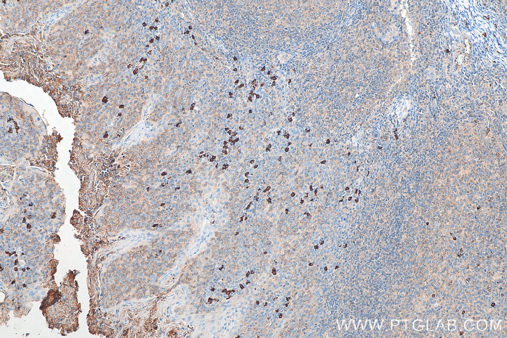 Immunohistochemistry (IHC) staining of human tonsillitis tissue using Biotin-conjugated Human IgA Monoclonal antibody (Biotin-60099)