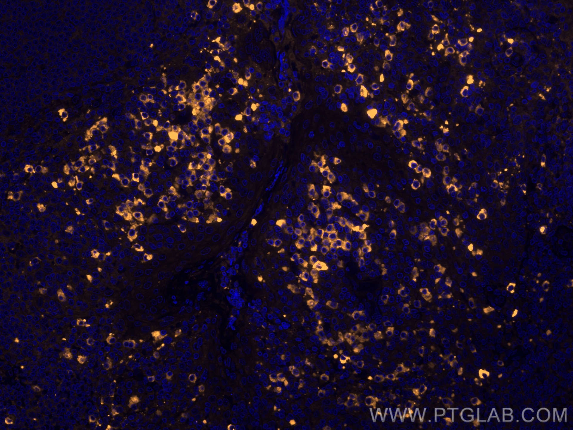 Immunofluorescence (IF) / fluorescent staining of human tonsillitis tissue using CoraLite® Plus 555-conjugated Human IgA Monoclonal (CL555-60099)