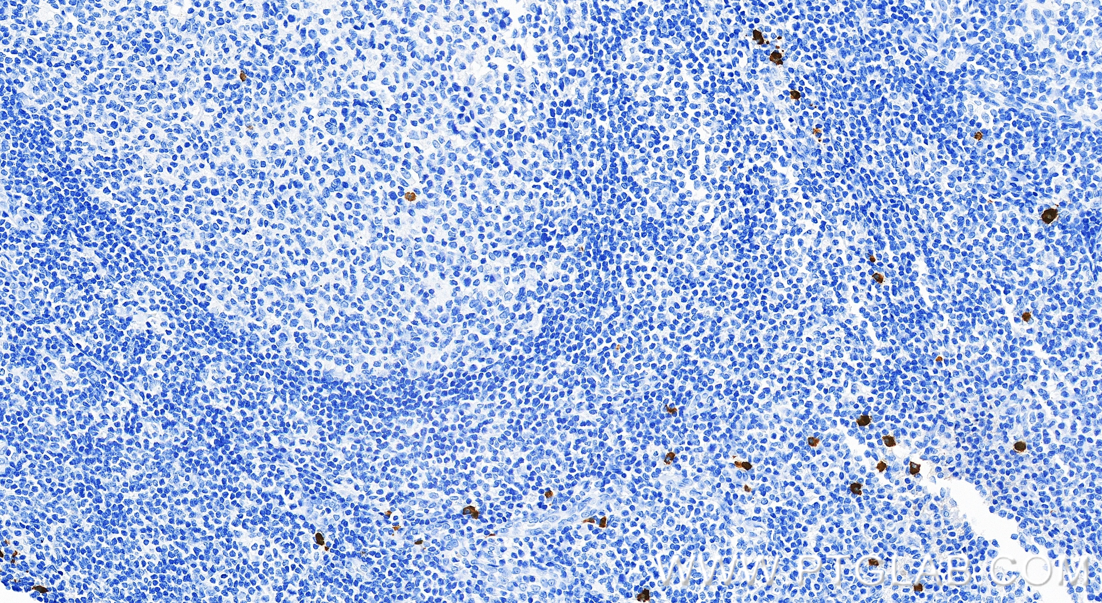Immunohistochemistry (IHC) staining of human tonsillitis tissue using Human IgA1 Recombinant monoclonal antibody (87606-3-RR)