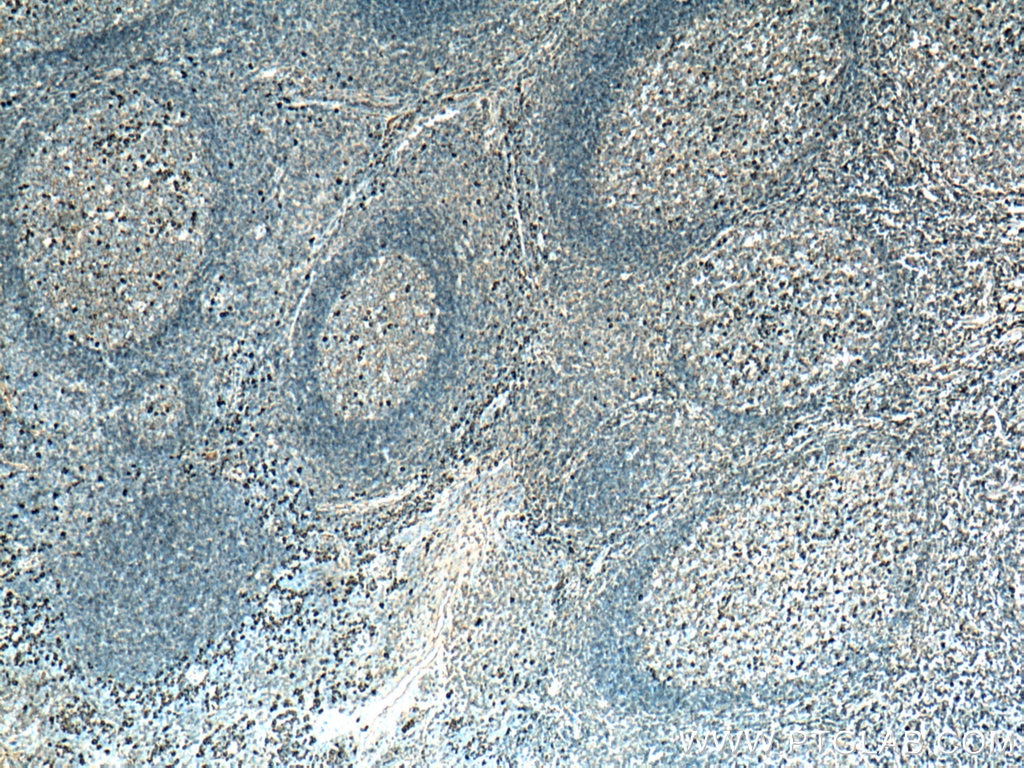 IHC staining of human tonsillitis using 10284-1-AP