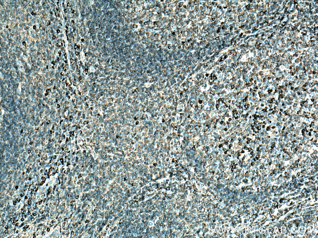 Immunohistochemistry (IHC) staining of human tonsillitis tissue using Human IgG Polyclonal antibody (10284-1-AP)