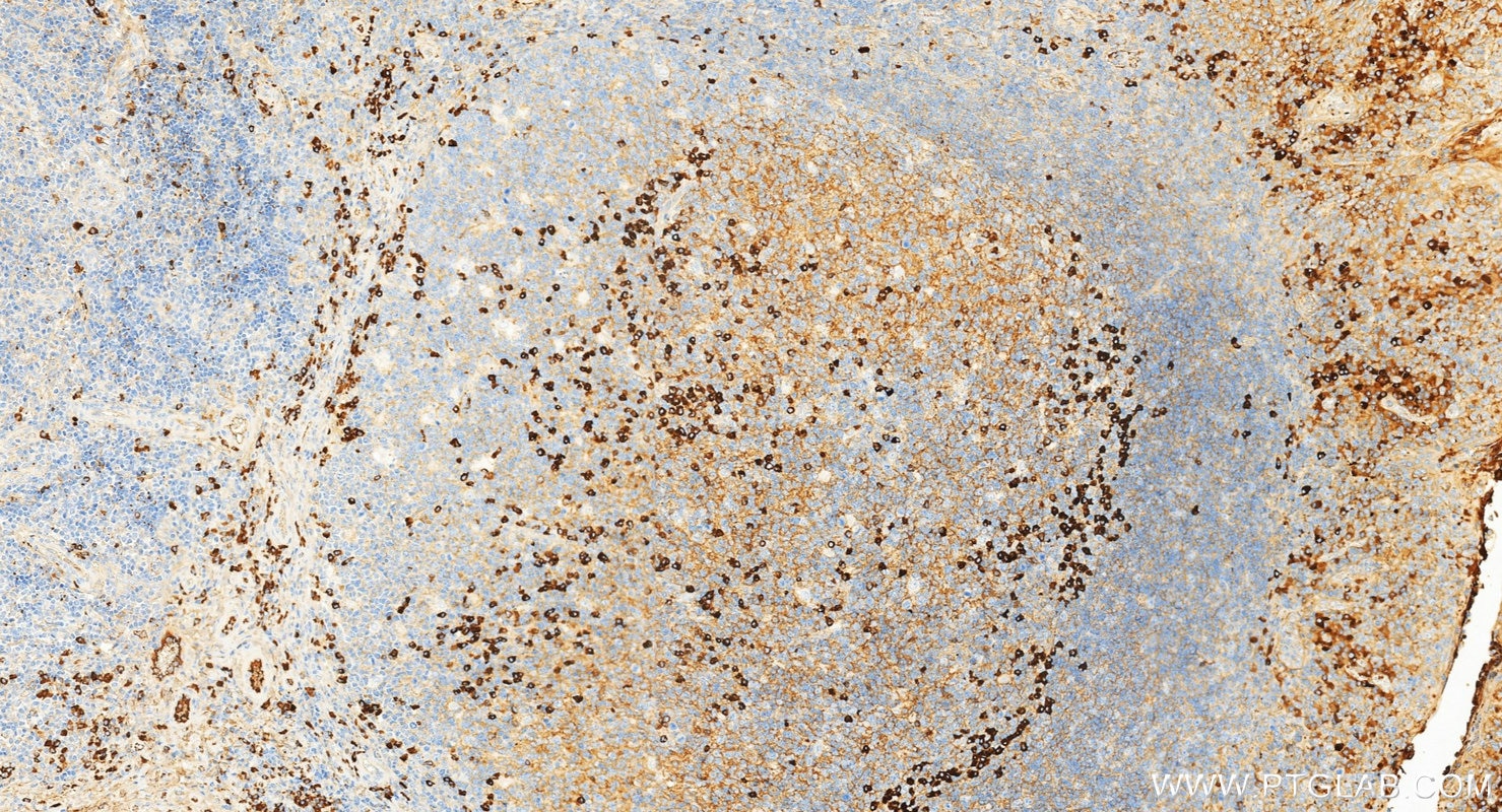 IHC staining of human tonsillitis using 10284-1-AP Immunohistochemistry (IHC) staining of human tonsillitis tissue using Rabbit Anti-Human IgG Polyclonal antibody (10284-1-AP)
