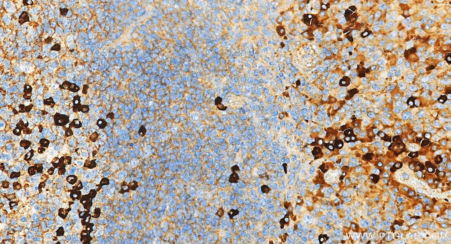 IHC staining of human tonsillitis using 10284-1-AP Immunohistochemistry (IHC) staining of human tonsillitis tissue using Rabbit Anti-Human IgG Polyclonal antibody (10284-1-AP)