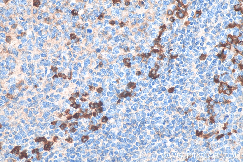Immunohistochemistry (IHC) staining of human tonsillitis tissue using Biotin-conjugated Human IgG Polyclonal antibody (Biotin-10284)