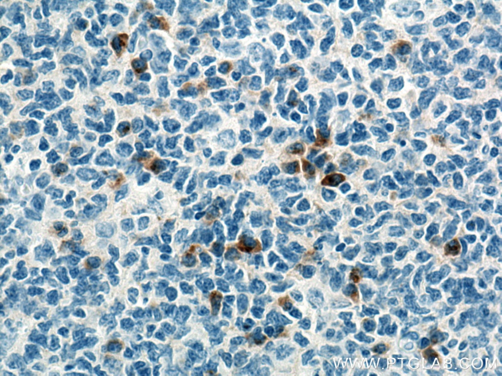 Immunohistochemistry (IHC) staining of human tonsillitis tissue using Human IgG Heavy chain Monoclonal antibody (67760-1-Ig)