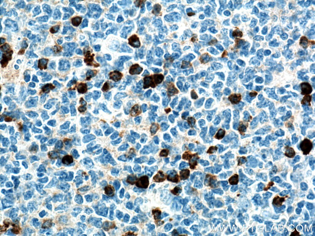 Immunohistochemistry (IHC) staining of human tonsillitis tissue using Human IgG Kappa chain Monoclonal antibody (67761-1-Ig)