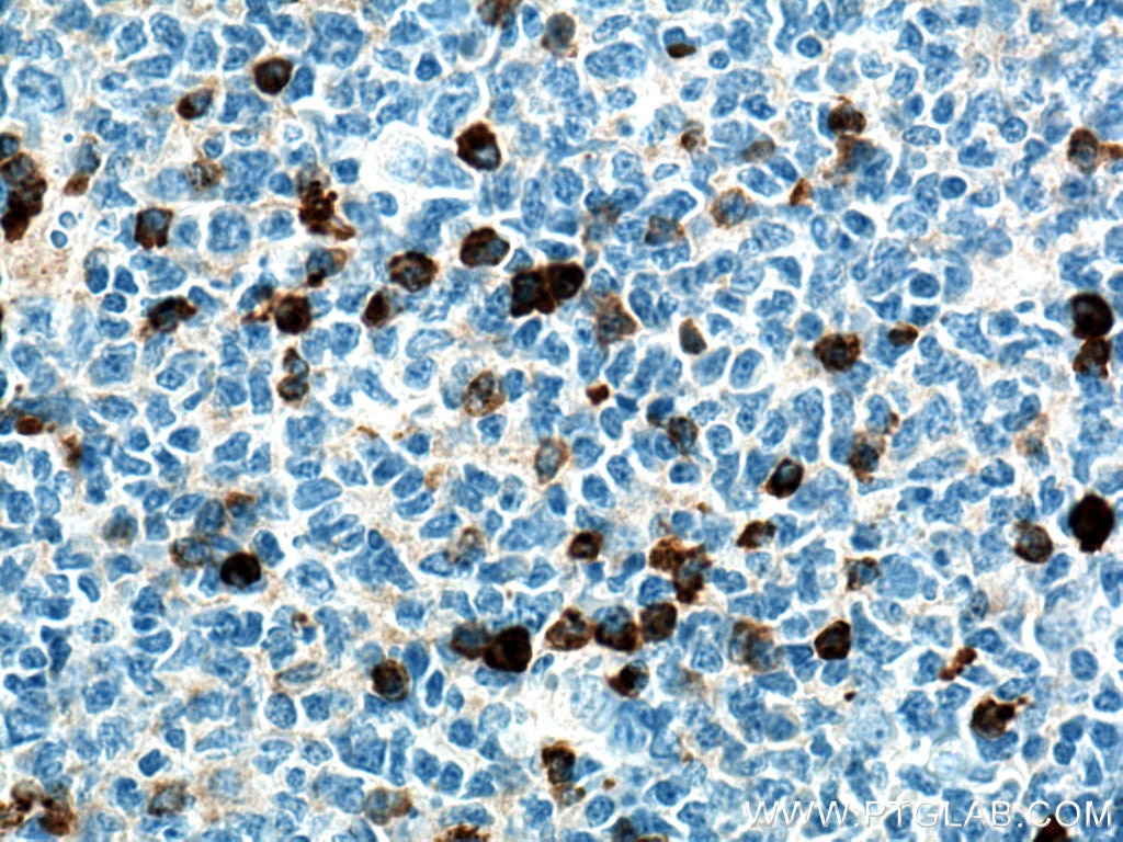 IHC staining of human tonsillitis using 67761-1-Ig