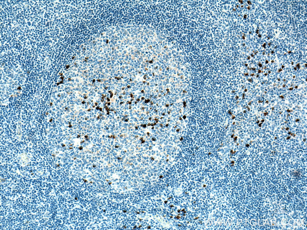 IHC staining of human tonsillitis using 67761-1-Ig