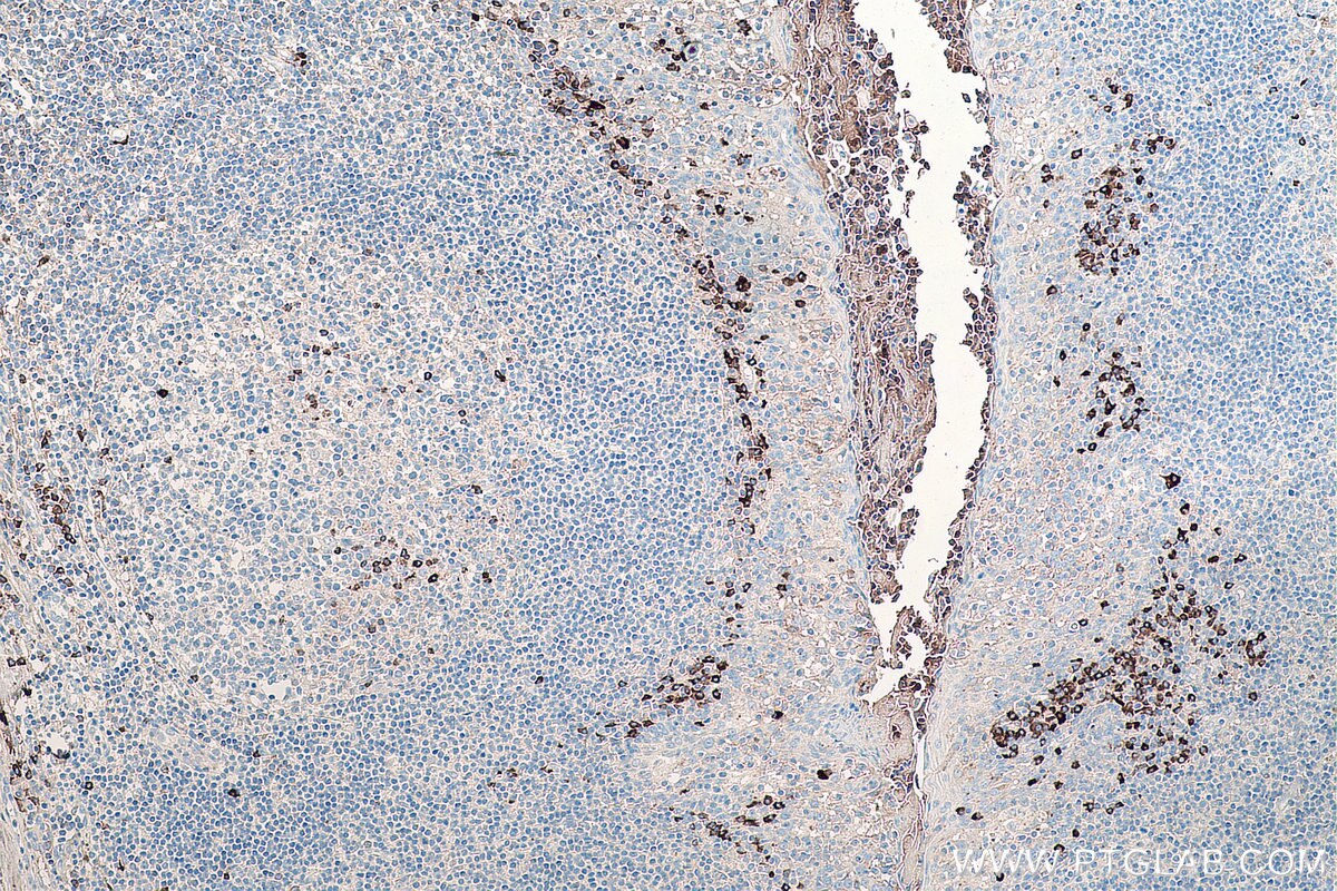 IHC staining of human tonsillitis using 67761-1-Ig Immunohistochemistry (IHC) staining of human tonsillitis tissue using Human IgG Kappa chain Monoclonal antibody (67761-1-Ig)