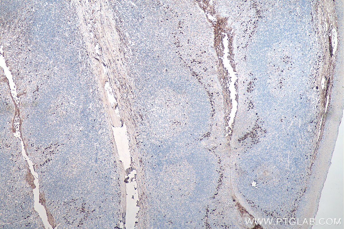 IHC staining of human tonsillitis using 67761-1-Ig Immunohistochemistry (IHC) staining of human tonsillitis tissue using Human IgG Kappa chain Monoclonal antibody (67761-1-Ig)