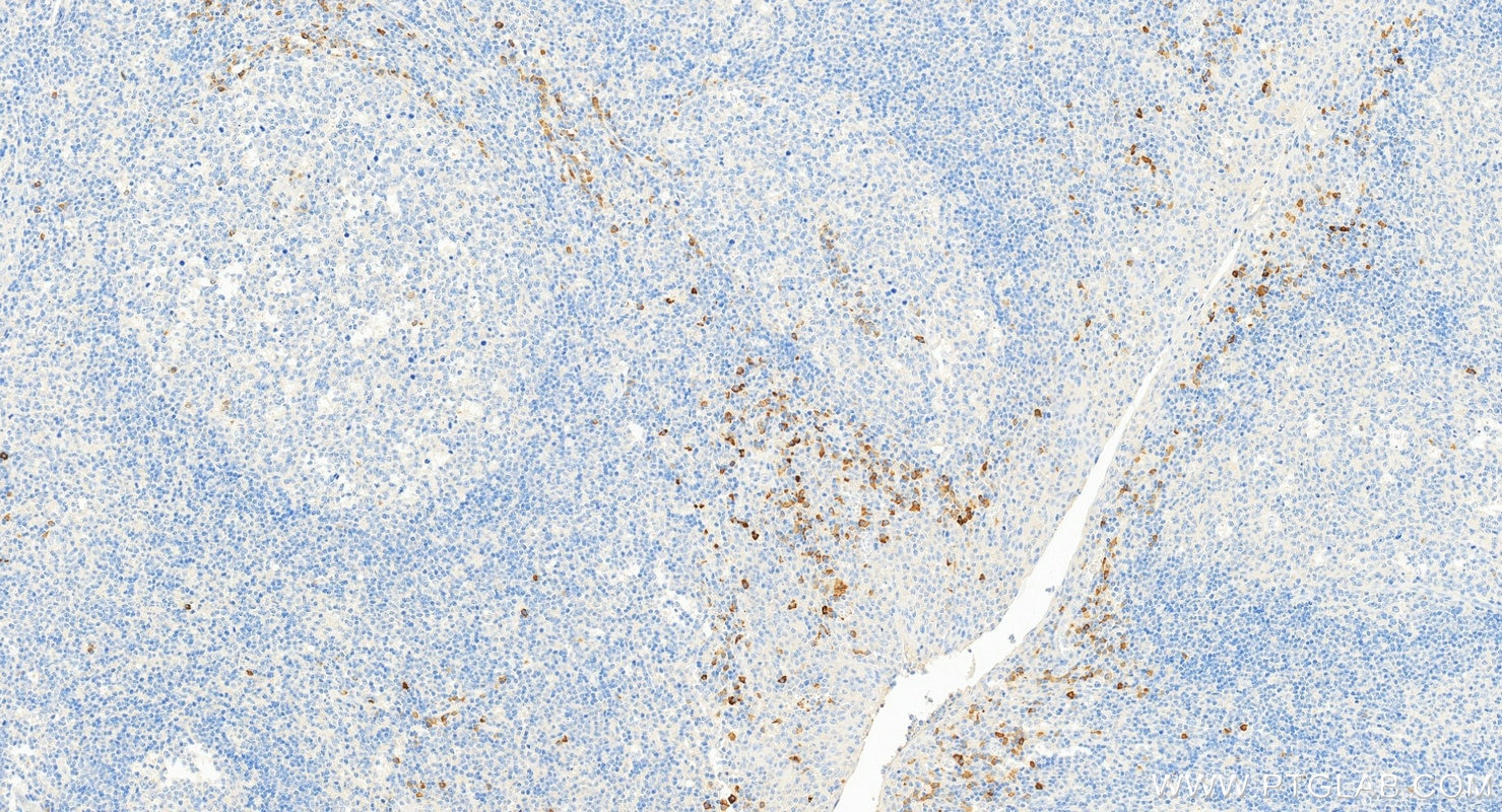 IHC staining of human tonsillitis using 67761-1-Ig Immunohistochemistry (IHC) staining of human tonsillitis tissue using Human IgG Kappa chain Monoclonal antibody (67761-1-Ig)