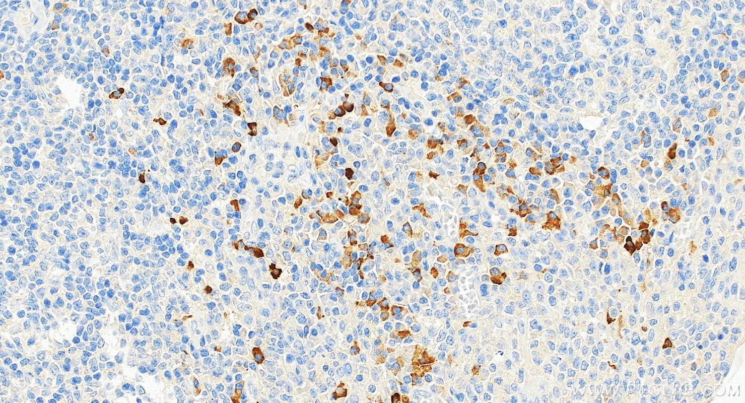 IHC staining of human tonsillitis using 67761-1-Ig Immunohistochemistry (IHC) staining of human tonsillitis tissue using Human IgG Kappa chain Monoclonal antibody (67761-1-Ig)