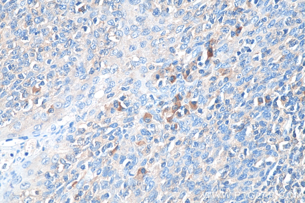 Immunohistochemistry (IHC) staining of human tonsillitis tissue using Biotin-conjugated Human IgG Kappa chain Monoclonal (Biotin-67761)