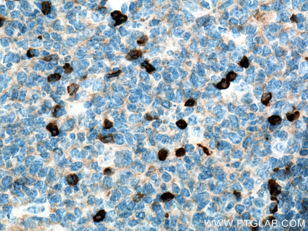 Immunohistochemistry (IHC) staining of human tonsillitis tissue using Human IgG lambda chain Monoclonal antibody (67762-1-Ig)