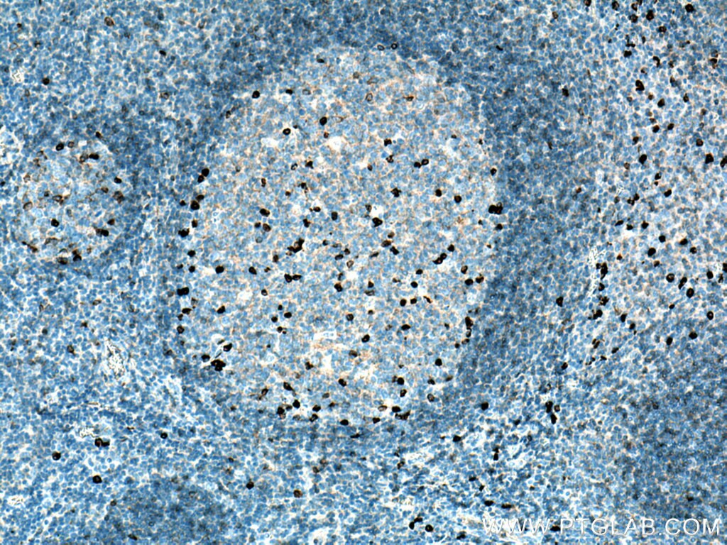 Immunohistochemistry (IHC) staining of human tonsillitis tissue using Human IgG lambda chain Monoclonal antibody (67762-1-Ig)