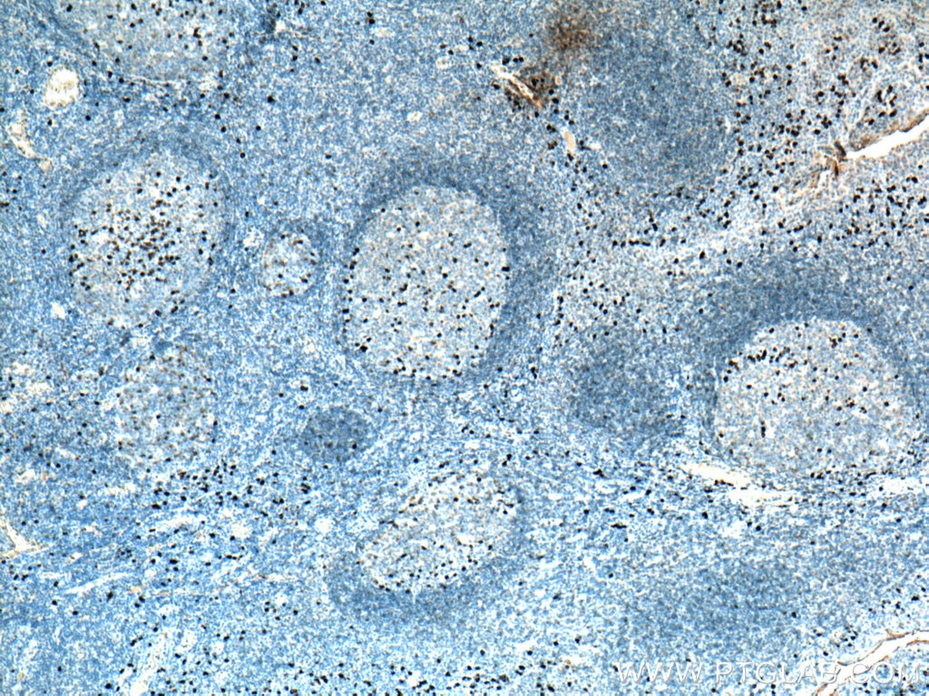 IHC staining of human tonsillitis using 67762-1-Ig