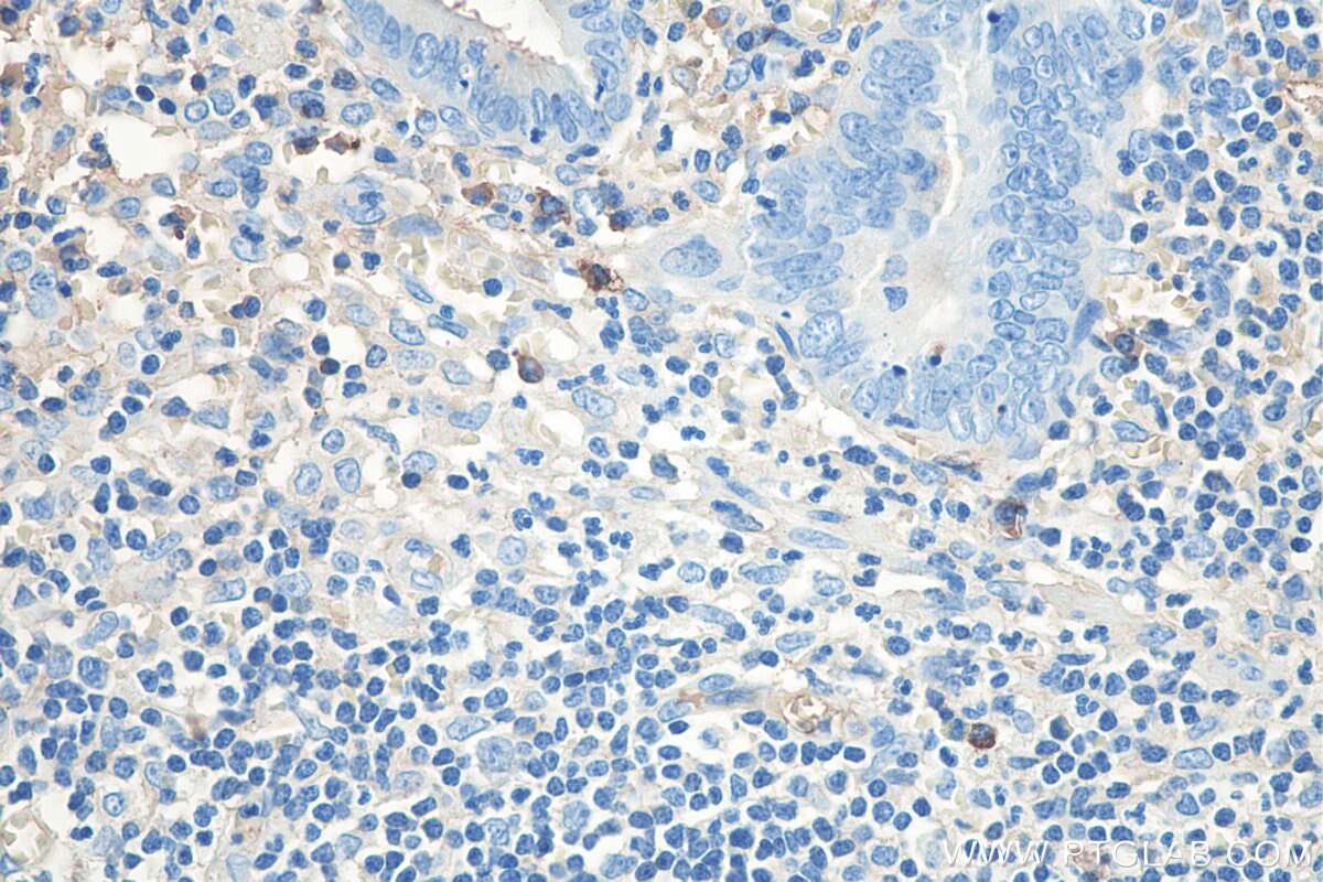 IHC staining of human appendicitis using 67762-1-Ig Immunohistochemistry (IHC) staining of human appendicitis tissue using Human Ig lambda chain Monoclonal antibody (67762-1-Ig)