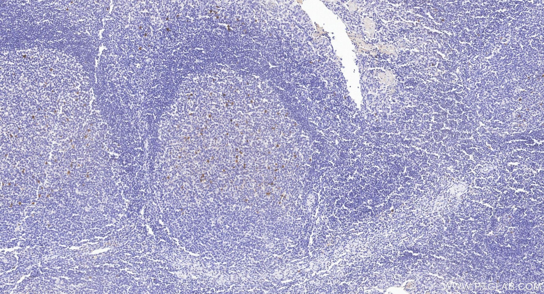 IHC staining of human tonsillitis using 87380-1-RR Immunohistochemistry (IHC) staining of human tonsillitis tissue using Human IgM Recombinant monoclonal antibody (87380-1-RR)