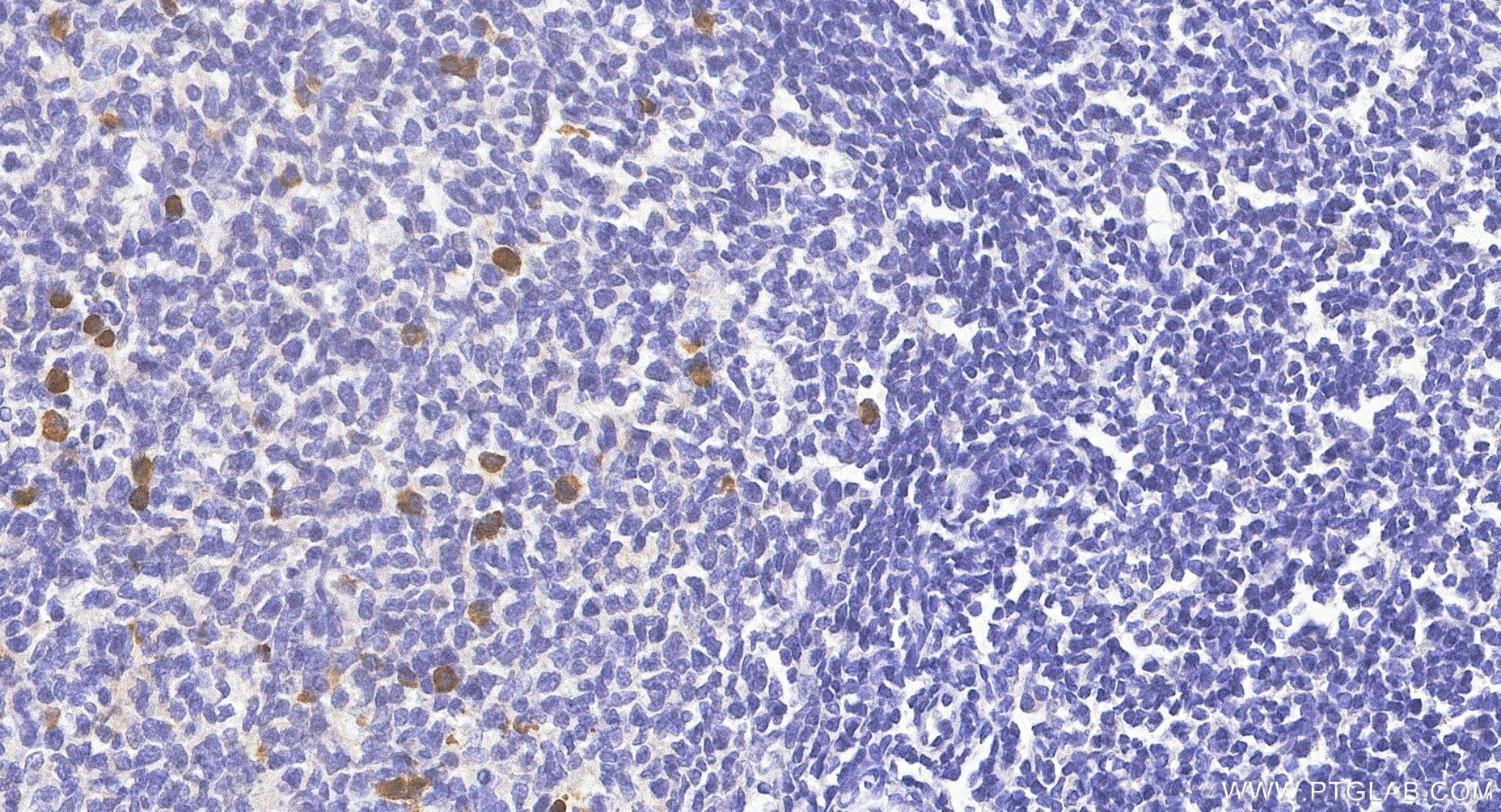 IHC staining of human tonsillitis using 87380-1-RR Immunohistochemistry (IHC) staining of human tonsillitis tissue using Human IgM Recombinant monoclonal antibody (87380-1-RR)