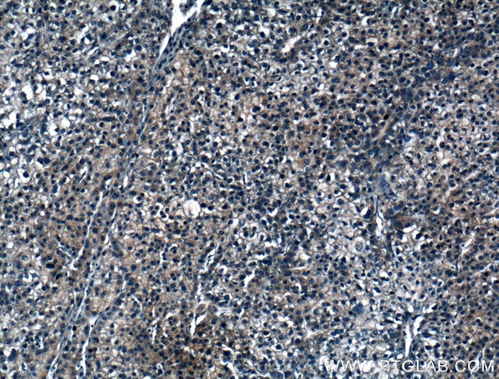 Immunohistochemistry (IHC) staining of human liver cancer tissue using IARS Polyclonal antibody (26942-1-AP)