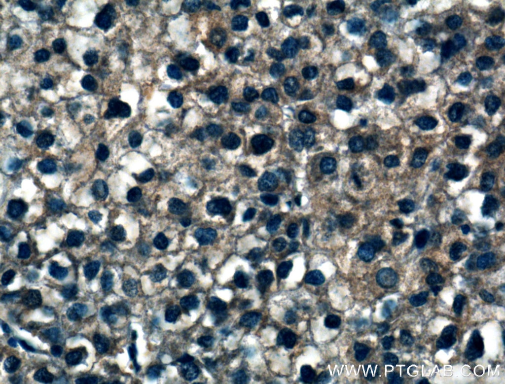 Immunohistochemistry (IHC) staining of human liver cancer tissue using IARS Polyclonal antibody (26942-1-AP)