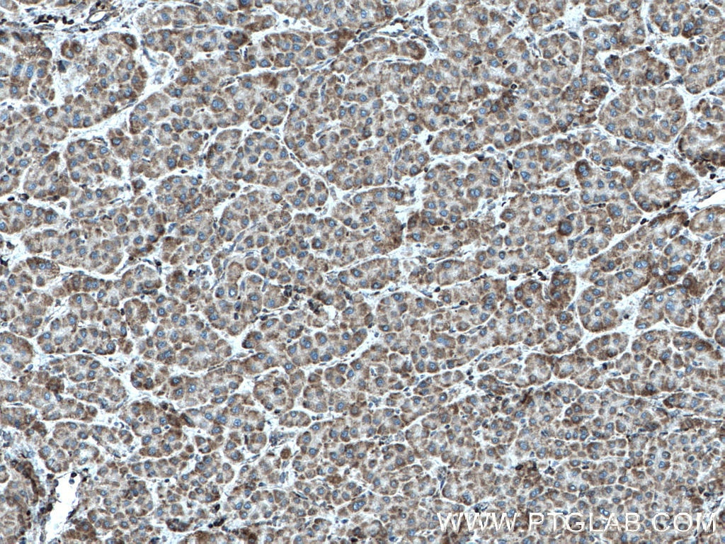 IHC staining of human liver cancer using 17170-1-AP