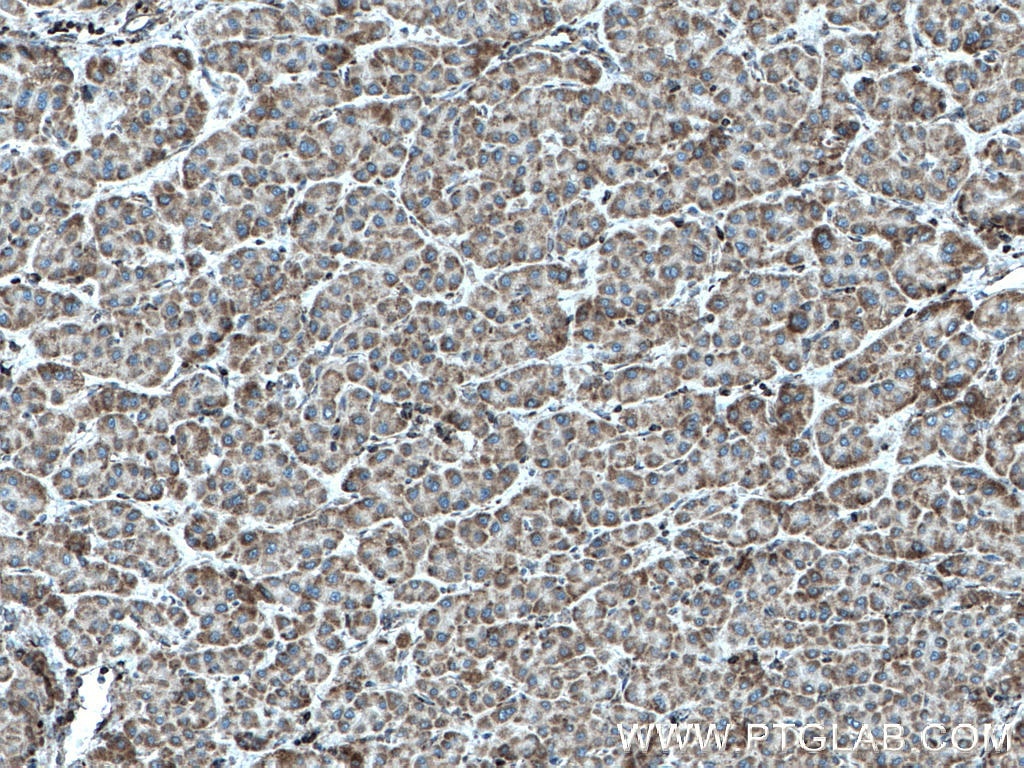 Immunohistochemistry (IHC) staining of human liver cancer tissue using IARS2 Polyclonal antibody (17170-1-AP)