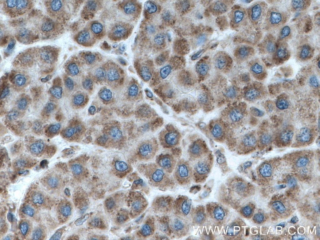 Immunohistochemistry (IHC) staining of human liver cancer tissue using IARS2 Polyclonal antibody (17170-1-AP)