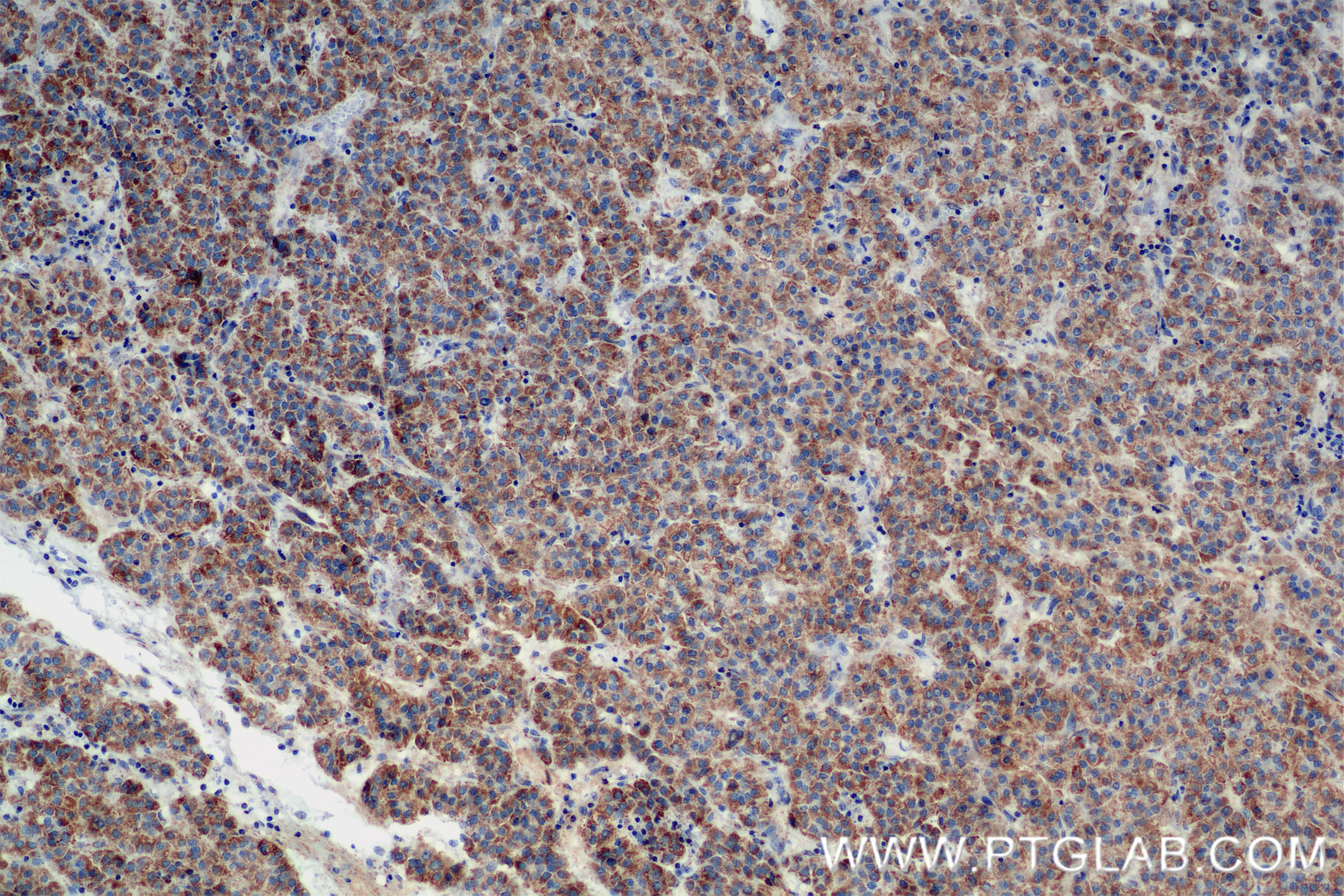 Immunohistochemistry (IHC) staining of Human Hepatocellular cancer using IARS2 Recombinant antibody (84764-3-RR)