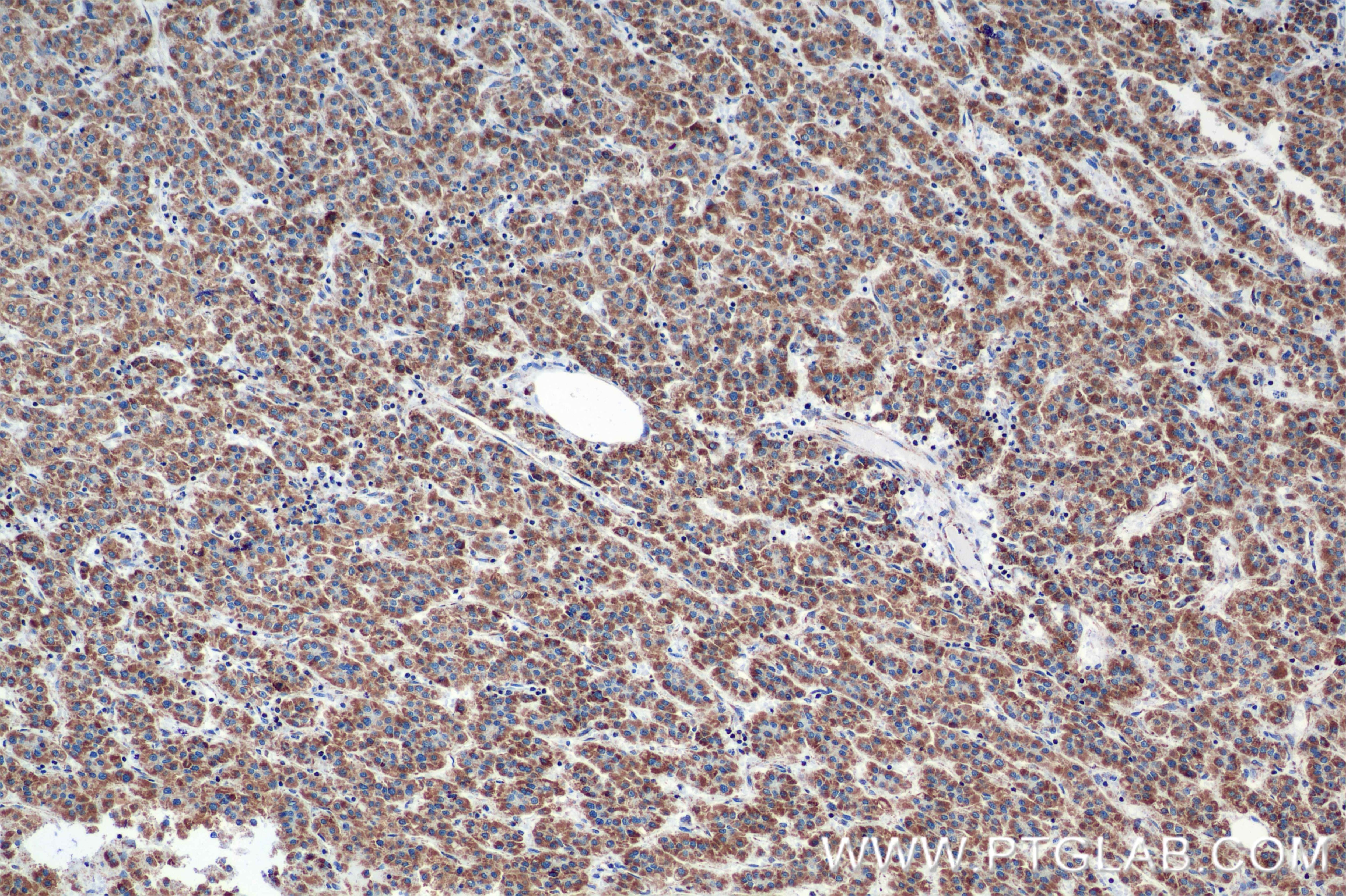 Immunohistochemistry (IHC) staining of human hepatocellular cancer using IARS2 Recombinant antibody (84764-5-RR)