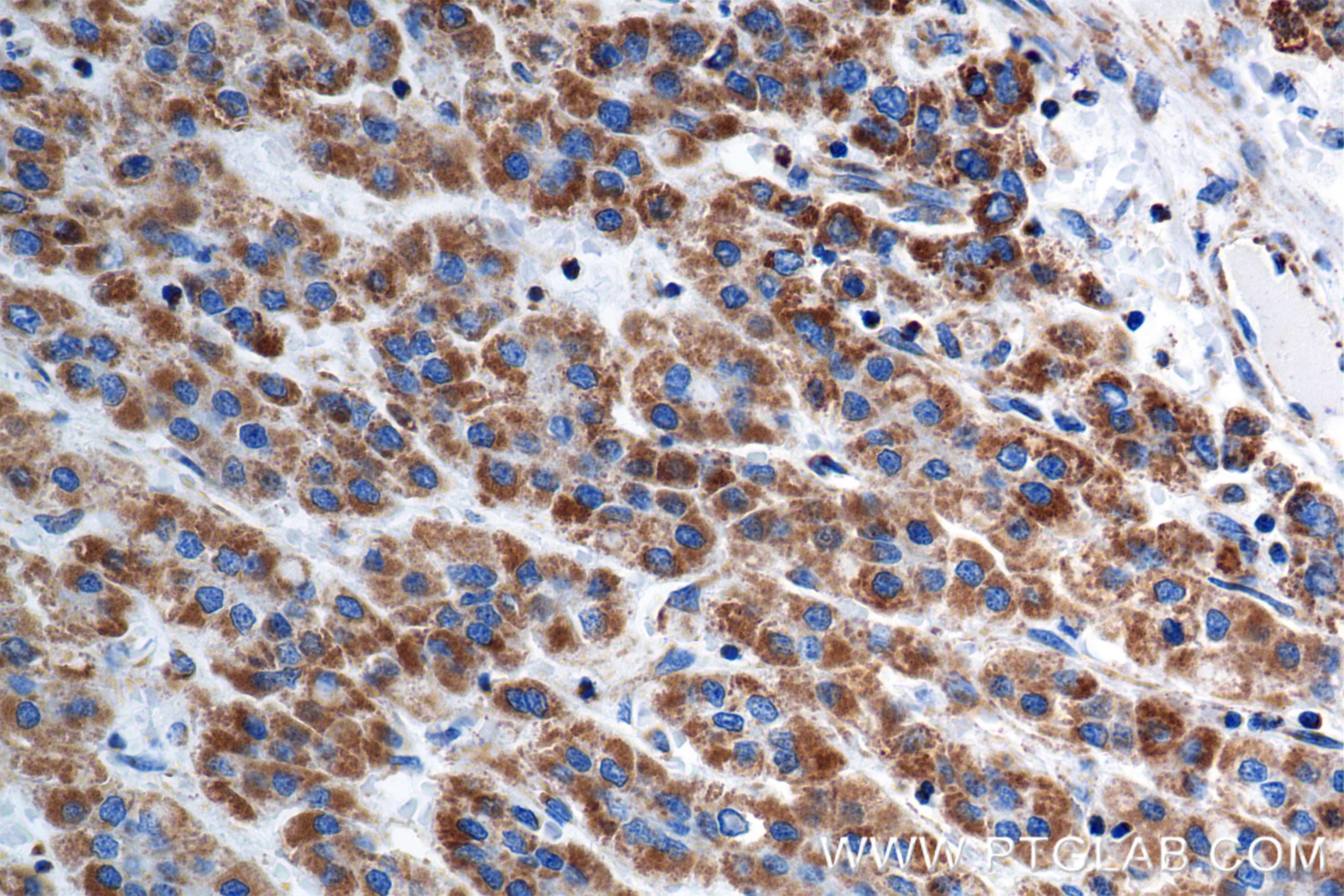 Immunohistochemistry (IHC) staining of human hepatocellular cancer using IARS2 Recombinant antibody (84764-5-RR)