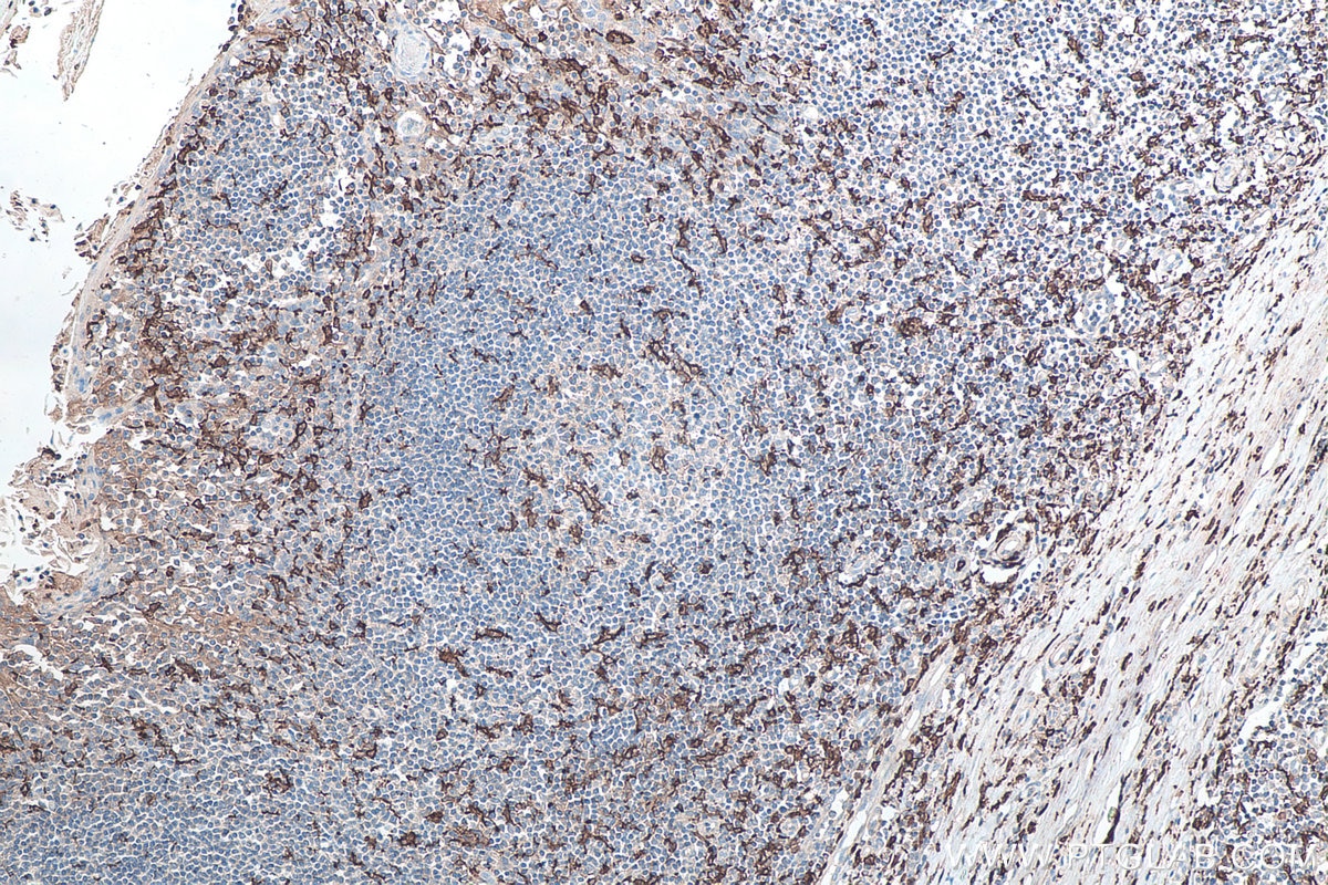 IHC staining of human tonsillitis using 10904-1-AP