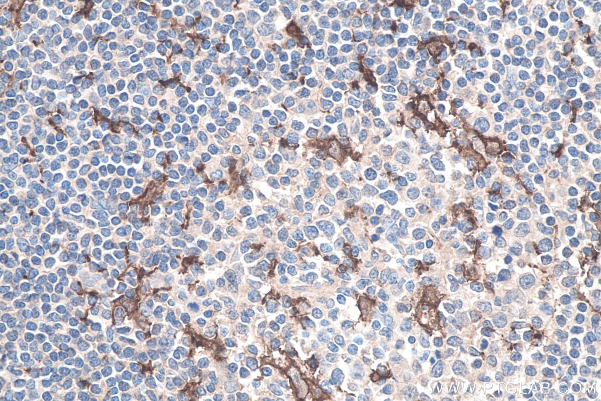 Immunohistochemistry (IHC) staining of human tonsillitis tissue using IBA1 Polyclonal antibody (10904-1-AP)