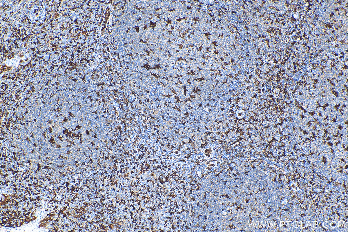 Immunohistochemistry (IHC) staining of human tonsillitis tissue using IBA1 Polyclonal antibody (10904-1-AP)